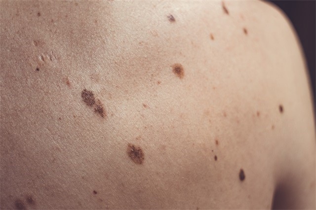 痣 黑色素瘤 皮肤癌 皮肤科-康兴医疗器械官网 痣 黑色素瘤 皮肤癌 皮肤科-康兴医疗器械官网