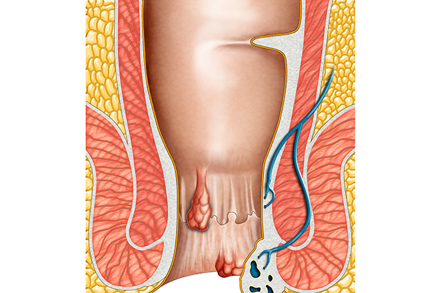 痔疮 内痔 便血 肛肠疾病-康兴医疗器械官网 痔疮 内痔 便血 肛肠疾病-康兴医疗器械官网
